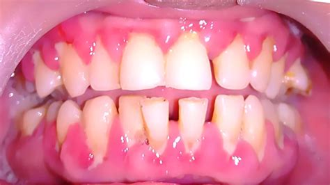 In this article, learn more about gum abscesses and how to. Periodontist-DrSomitJain - Prestige Dental Care
