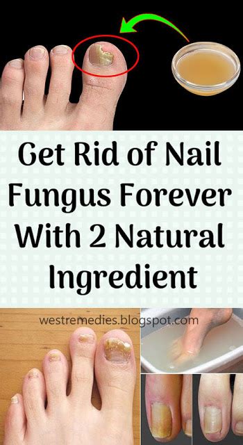 Get Rid Of Nail Fungus Forever 2 Ingredient Recipe Wellness Guru