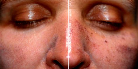 Sun Damage Actinic Keratoses Q Dermatology
