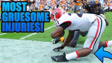 Top 10 Most Gruesome Injuries In Nfl History Youtube