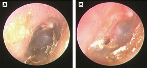 Otitis Media With Effusion Of The Right Ear A Before And B After