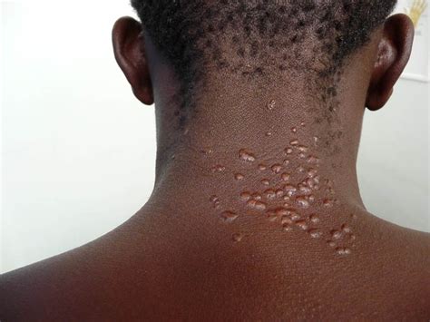 Signs And Symptoms Of Leishmaniasis