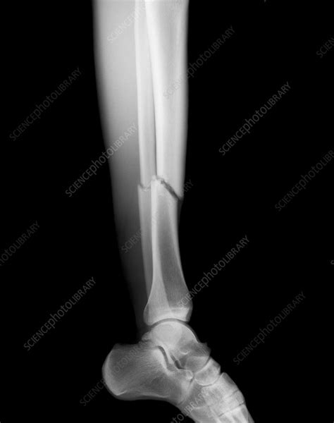 Broken Leg Stock Image M3300816 Science Photo Library