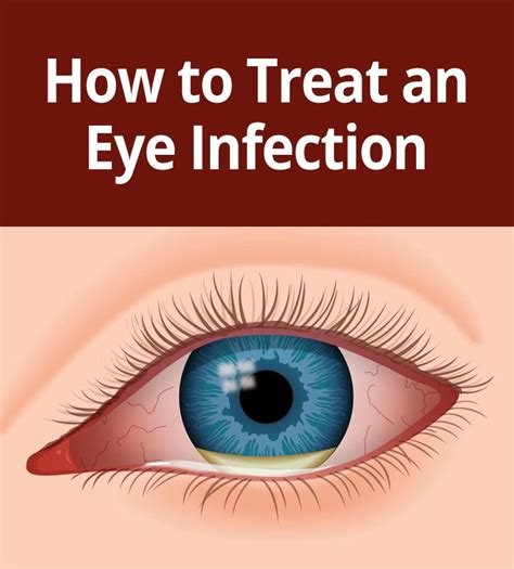 How To Tell If You Have An Eye Infection Eye Infections Bacterial