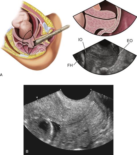 Ultrasound Evaluation Of The Gravid Cervix Obgyn Key