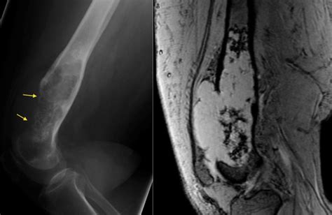 Chondrosarcoma Radiology At St Vincents University Hospital