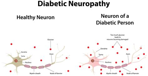 Diabetic Neuropathy What It Means How To Treat It University Health