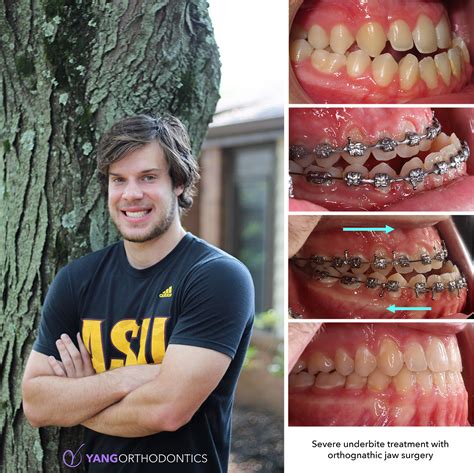 One Of Our Patients At Yang Orthodontics Had A Severe Underbite