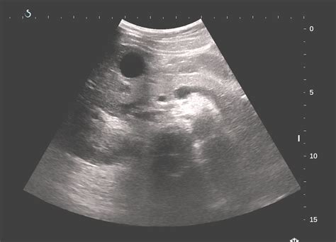 Press your left thumb just under the right costal margin and ask the patient to take a deep breath. VIETNAMESE MEDIC ULTRASOUND: CASE 363: MURPHY'S SIGN ...