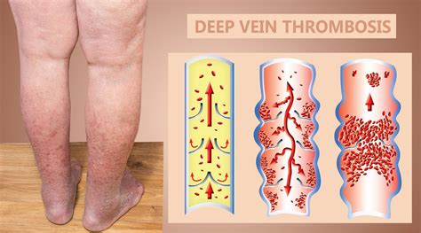 Chronic Venous Insufficiency Signs Symptoms And Complications Pedes