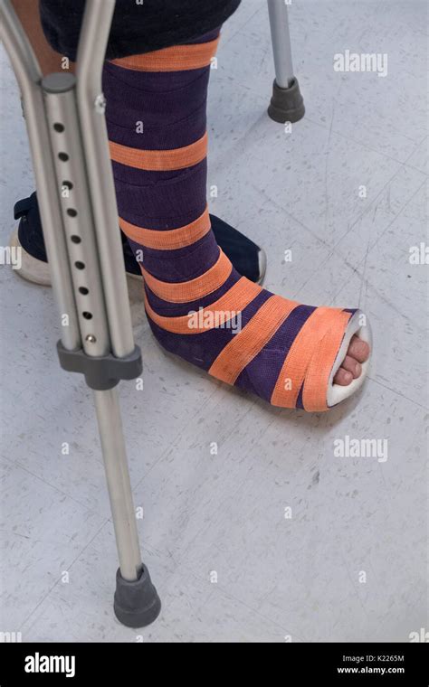 Orange Ankle Cast Hi Res Stock Photography And Images Alamy