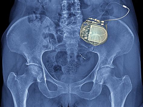 Nevro Touts 2 Year Data On Senza Spinal Cord Stim Oasis Surgical