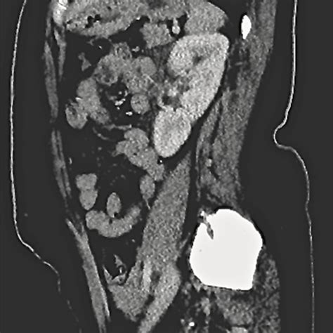 Abdominal Ct Scan With Intravenous And Oral Contrast Showing The Renal