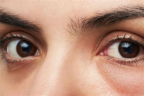 Eye Bags Treatments Brisbane Skin Dermatologists