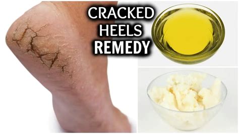 How To Heal Your Cracked Feet With These 6 Home Remedies Best Folk