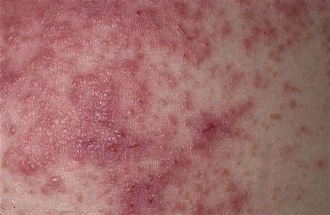 Aspecto De La Dermatitis Herpetiforme Medicina B Sica