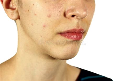 Girl With Bad Skin Acne And Black Heads Royalty Free Stock Image