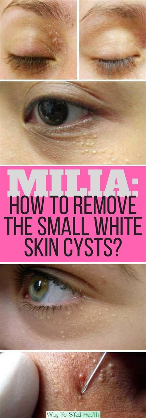 MILIA How To Remove The Small White Skin Cysts Skin Cyst Whiter Skin Skin