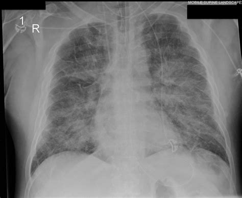 Whose Line Is It Anyway Pocus In A Patient With Dyspnea Department