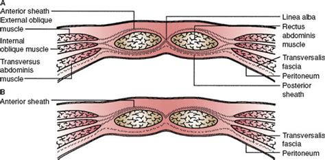 Abdominal Wall Hernias Basicmedical Key