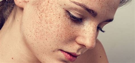 Everything You Need To Know About Getting Rid Of Freckles Vdg