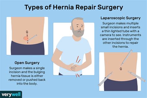 Hernia Repair Surgery Purpose Recovery And More