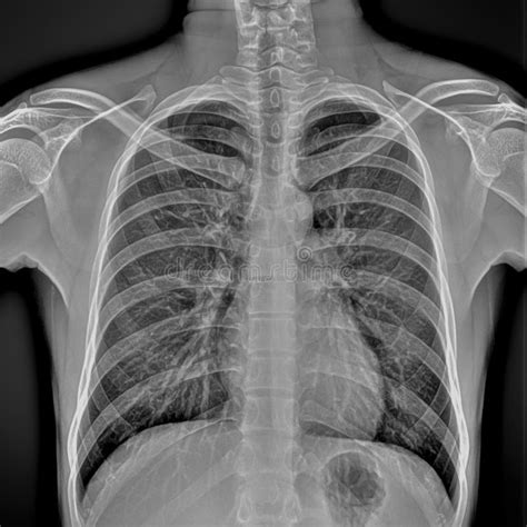 Chest Radiography Of A Hospital Patient Stock Photo Image Of Imaging