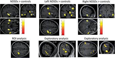Increased Grey Matter In Patients With Ndsds Compared To Healthy