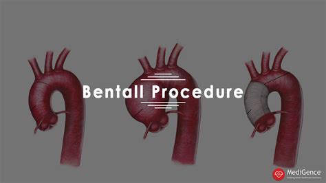 Bentall Procedure Causes Symptoms And Recovery