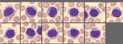 Hematology Case Study An Unusual Case Of Leukemic