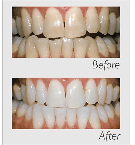 Tooth Whitening Deal Brisbane Tooth Whitening Healthy Teeth Dental