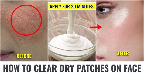 How To Fix Dry Patches On The Face Makeupandbeauty Com