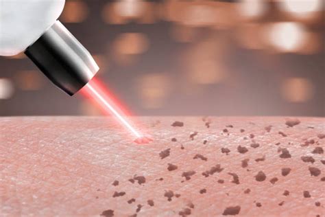 Laser Freckles Removal Cost In Singapore