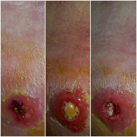 Mrsa Treating It Naturally My Journey With Mrsa Cellulitis