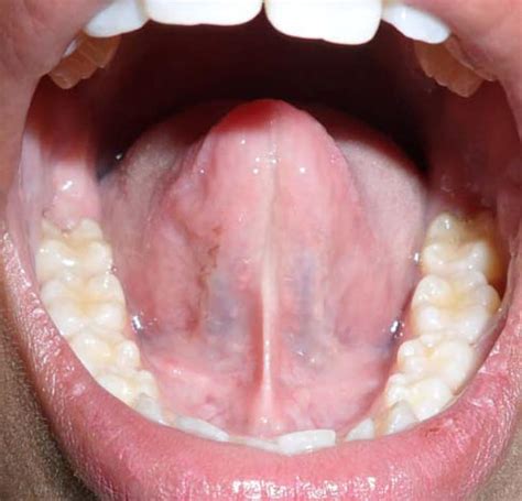 Tongue Tie Ankyloglossia Diagnosis Symptoms Surgery And More