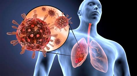 lung infection a guide to this disease