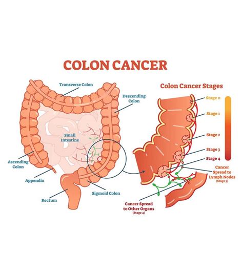 Polyps Female Colon Cancer Symptoms Colon Cancer The Angeles Clinic