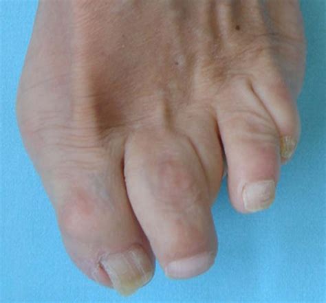 Left Underlapping Third Toe In A Patient Who Underwent Ventricular