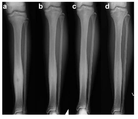 Conservative Treatment For Patients With Osteoid Osteoma A Case Series