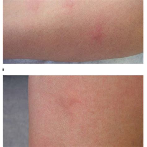 Classification Of Urticaria Overview The 48 Hour Cut Off Refers To