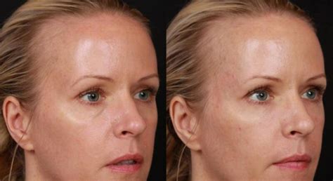 Restylane Irvine Facial Filler Orange County Total Dermatology