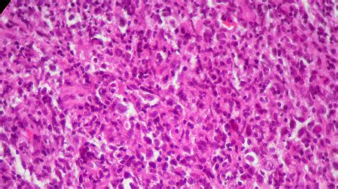 Angiocentric T Cell Lymphoma With Origin Of Lethal Midline Granulomas