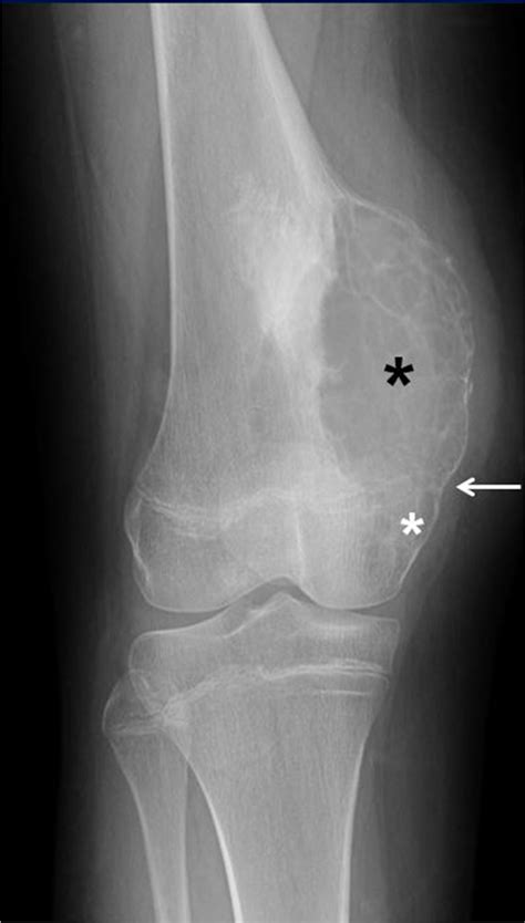 Epiphyseal Extension Of An Aneurysmal Bone Cyst Of The Left Distal