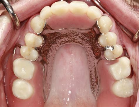 Maxillary Removable Partial Denture