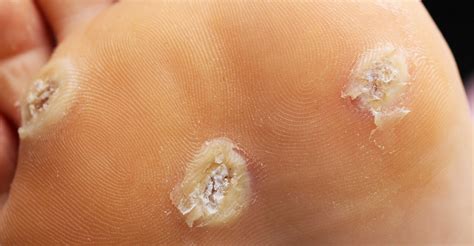 Plantars Warts — Woodlake Podiatry Llc