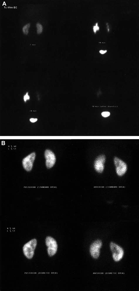 A Tc 99m Ec Images Of A Patient With A Nonobstructive Dilated Left
