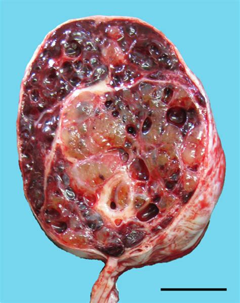 Testicular Yolk Sac Tumor Of Myxomatous Reticular And Polyvesicular