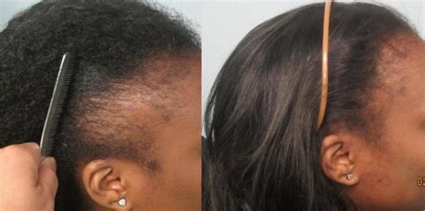 We did not find results for: African American Hair Transplant