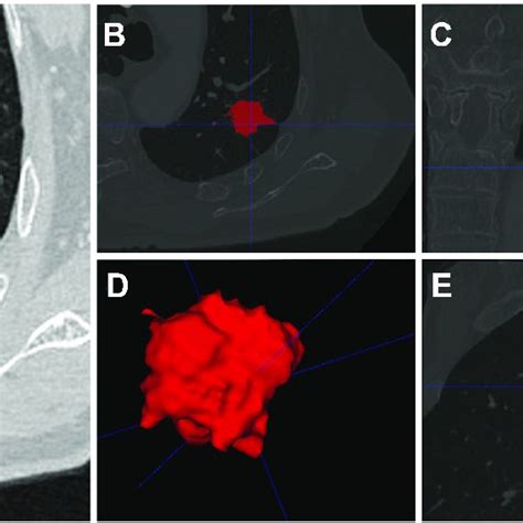 Lung Adenocarcinoma In The Apicoposterior Segment Of The Left Upper