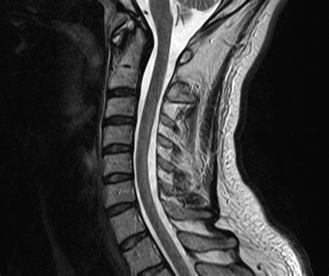 Ich hatte zuerst ein mrt lws vom orthopäden, der rheumadoc hat dann ein mrt gesamte ws angefordert, um auch isg und restlichen rücken beurteilen zu können. Fallsammlung | Radiologie Herne Ihre Radiologen für ...